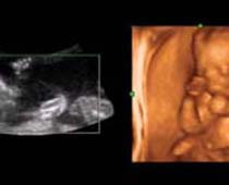 4D Ultrasound a fetus Boxing