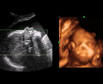 4D Ultrasound of a twenty seven weeks old fetus 1