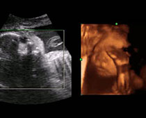 4D Ultrasound of a 27 weeks old fetus clip 2