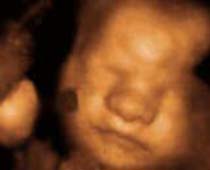 4D Ultrasound Facial Expressions of a fetus.clip 3